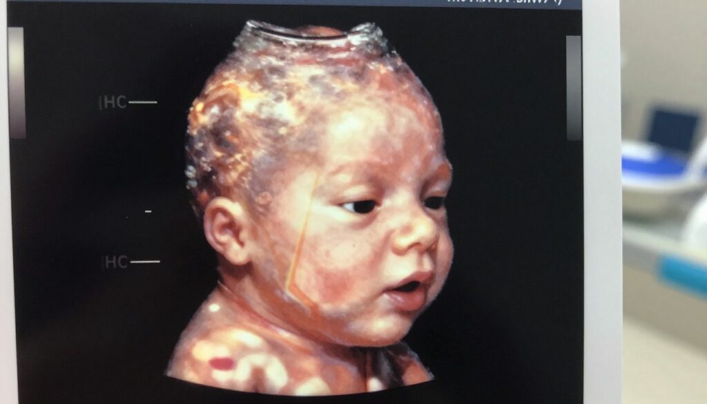 A close-up view of a detailed ultrasound image showing the head of a fetus, focusing on features such as the cranial shape and measurements. The foreground captures the distinct outlines of the fetal head, with a soft glow illuminating it from a side angle. In the middle ground, prominent anatomical landmarks like the biparietal diameter (BPD) and head circumference (HC) are highlighted with subtle color variations to indicate measurements. The background consists of a soft, blurred medical setting, giving a sense of professionalism and clinical atmosphere. The image should be well-lit, with a calm and neutral color palette that conveys a sense of clarity and precision in medical imaging.