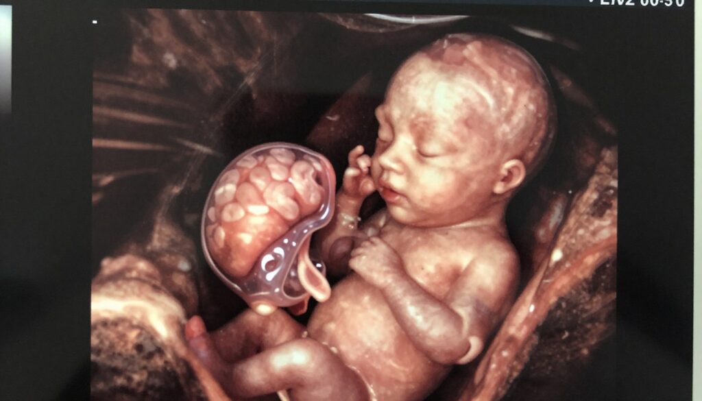 A detailed ultrasound image showcasing amniotic fluid in a developing fetus. In the foreground, visualize a clear view of a healthy, well-defined fetal brain and heart, illuminated with soft, natural light to enhance anatomical features. The middle layer should include a depiction of fluid surrounding the fetus, giving a sense of protection and clarity, with subtle reflections to illustrate its transparency. In the background, create a soft focus of the uterine cavity, allowing the viewer to grasp the context of the ultrasound setting, such as gentle curvatures of the uterus. Use a medical imaging perspective, akin to a standard obstetric ultrasound, to convey the scientific nature of the subject. The overall mood should be calm and informative, highlighting the importance of these anatomical elements in fetal health.
